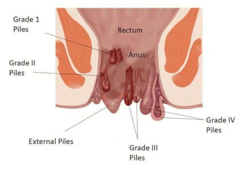 Ano-Rectal Diseases