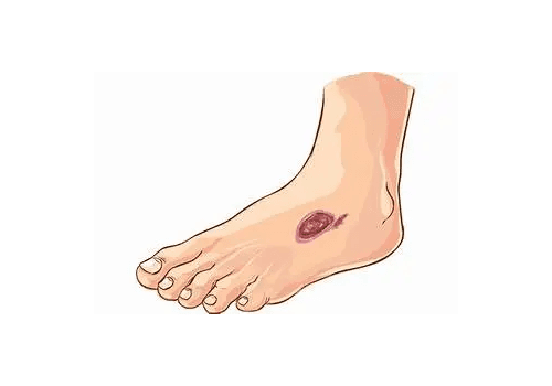 Arterial Ulcers