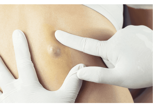 Cyst