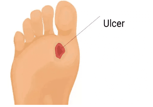 Diabetic Foot Ulcer