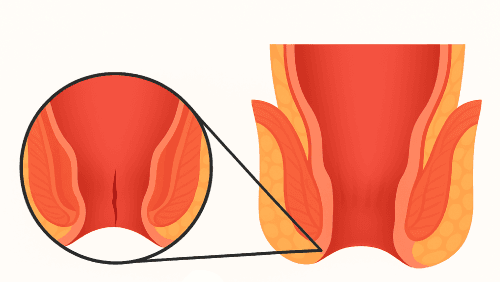 Anal Fissure
