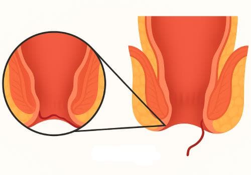 Anal Fistula