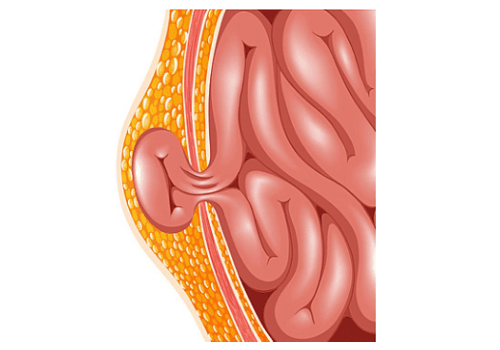 Hernia
