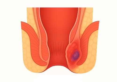 Perianal Abscess