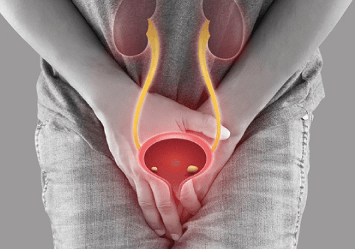 Urinary Stones