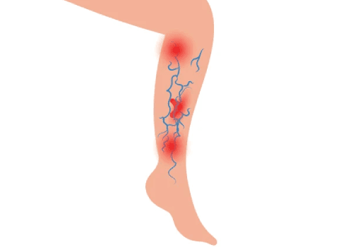 Venous Ulcers