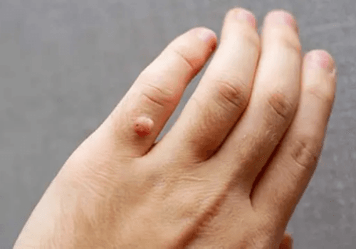 Warts